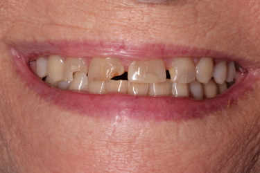 Before Smile Photo